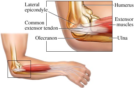 Illustration of tendons and muscles involved in tennis elbow or lateral epicondylitis
